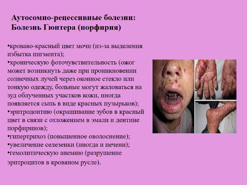 кроваво-красный цвет мочи (из-за выделения избытка пигмента); хроническую фоточувствительность (ожог может возникнуть даже при